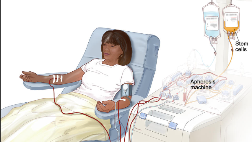 Cấy ghép tế bào gốc tạo máu điều trị ung thư